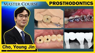 Master Course Season2 PROSTHODONTICS Design of Posterior Implant Prosthesis [upl. by Corkhill]