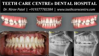 Invisalign Before and After  Premolar Extraction Case [upl. by Eidur]