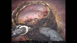 Robotic Microwave Ablation  Partial hepatectomy [upl. by Claud]