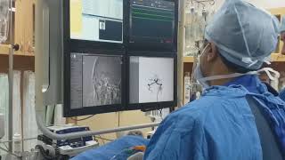 Live stroke treatment by clot retrieval [upl. by Htelimay645]