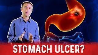 How To Get Rid Of Stomach Ulcer – DrBerg On Peptic Ulcer Treatment [upl. by Holleran]