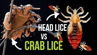 Crab Lice vs Head Lice  What is the Difference [upl. by Oigile]