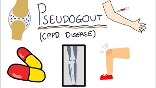 Pseudogout Calcium Pyrophosphate Disease  Simple and easy to understand [upl. by Darees306]