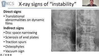 What might indicate a mobile listhesis in the lumbar spine [upl. by Sybley]