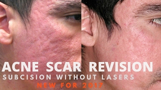 In 7 DAYS  Remove DARK SPOTS ACNE SCARS PIMPLE MARKS amp PIGMENTATION in JUST 7 DAYS  100 RESULTS [upl. by Ellohcin507]