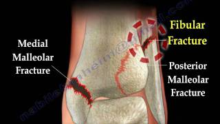 Ankle fracture  Fractures and its repair Everything You Need To Know  Dr Nabil Ebraheim [upl. by Therine]