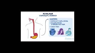 Achalasia A Disorder of the Esophagus health [upl. by Akired477]