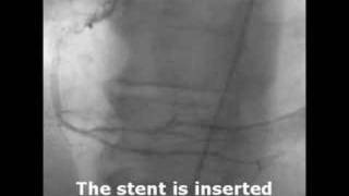 What A Diffenence A Stent Makes [upl. by Uriiah]