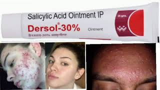 Dersol 30 Ointment Salicylic Acid Ointment IP [upl. by Godiva825]