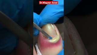 DRAINAGE OF WICKED ABSCESS💦shorts [upl. by Notsniw277]