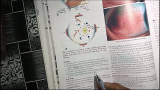 episcleritis in hindi  youtube  video [upl. by Riehl]