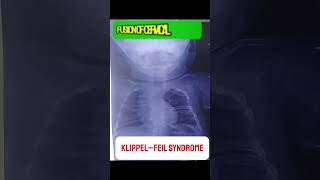 KlippelFeil Syndrome  Congenital Musculoskeletal Disorder medicalstudent mbbs doctor [upl. by Abey]