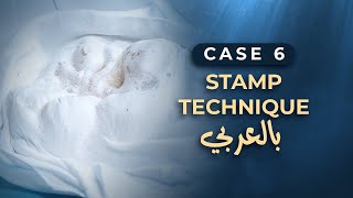 Stamp Technique بالعربي I Case 6 [upl. by Eibber226]