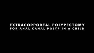 Extracorporeal polypectomy for anal canal polyp in a child [upl. by Aihgn152]