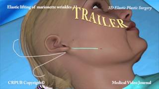 3D Elastic lifting of marionette wrinkles 11 [upl. by Matta105]