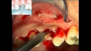 Osseous Resective Surgery  Crown Lengthening pt1 [upl. by Hershel761]