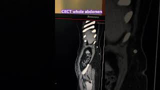 CECT whole abdomen Hernia problems trending anatomy ctscan abdoabdoherniation contrast [upl. by Anitserp61]