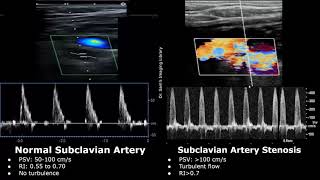 Subclavian Artery Doppler Ultrasound Normal Vs Abnormal Images  Stenosis amp Steal Syndrome USG [upl. by Castorina]