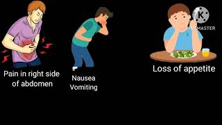 Appendicitis Definition Cause symptoms management [upl. by Buffy]