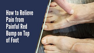 PAIN RELIEF FOR RED BUMP ON TOP OF FOOT [upl. by Danais624]