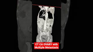 Carcinoma Ovaries with Multiple Metastasis CT scan [upl. by Eleets]