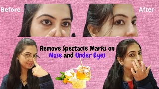 Remove spectacle marks on nose and under eyes [upl. by Ivar]