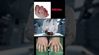 Chilblains Swelling in hands and feet [upl. by Anahsal]