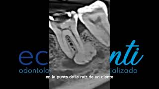 Cementoblastoma cementoma [upl. by Erde]