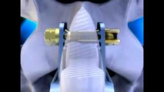 The coflexF® Rivet  Paradigm Spine  Spine Treatment amp Surgery [upl. by Thinia982]