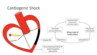 Cardiogenic Shock [upl. by Francklyn311]