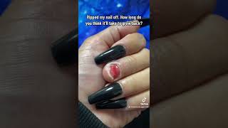 Fingernail Ripped From Nail bed [upl. by Darelle]