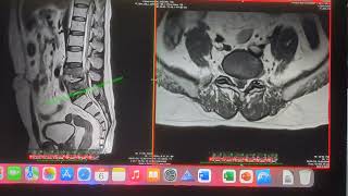 MRI Lumbar Spine Sequence Sagittal amp Axial Sections Reading beginners anatomy [upl. by Peednam]