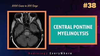 CENTRAL PONTINE MYELINOLYSIS Radiology Tutorials 1000 videos in 100 days video 38 [upl. by Bellaude]