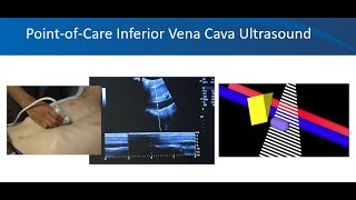 Renal ultrasound video 3 Volume status University of Florida Nephrology Dr Koratala NephroP [upl. by Rebma260]