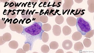 Downey cells reactive lymphocytes in MonoInfectious MononucleosisEBVEpsteinBarr Virus [upl. by Whitebook614]