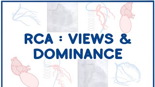 Right Coronary Artery Angiogram Views amp Dominance [upl. by Dias]