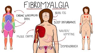 Fibromyalgia  A Chronic Pain Disorder Includes Symptoms Criteria amp Treatment Options [upl. by Goeger]