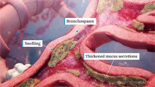 What Is Severe Asthma [upl. by Ferde]