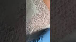 Watch how we remove a shard of glass under the foot 🤕 [upl. by Eninahpets794]