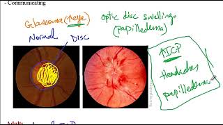 USMLE ACE Video 199 Overview of Hydrocephalus Types and Associated Conditions [upl. by Adnawal86]