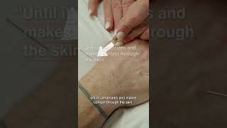 Acupuncture Therapy For Thumb Pain Relief [upl. by Keil]