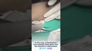 Incision amp Draining of Pus  Surgery Pus  Surgery Drainage  Gumboil  Infected Tooth [upl. by Annawd777]