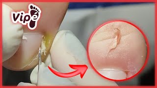 PODOLOGIA EM UNHA ENCRAVADA OVERGROWN INFECTED INGROWN TOENAIL REMOVAL [upl. by Eric]