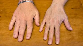 Difference Between Gigantism and Acromegaly [upl. by Amlus]