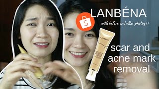 Lanbena Acne Mark and Scar Removal Gel Ointment Review  Shopee Skincare [upl. by Suiramed]