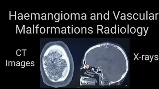 Hamangioma and vascular malformations Radiology Xrays and CT images [upl. by Hobbie926]