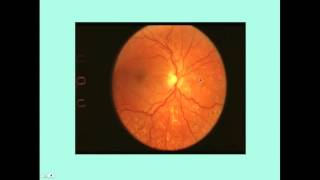 Hypertensive Retinopathy  CRASH Medical Review Series [upl. by Nyar139]