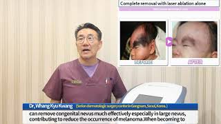 How to treat congenital nevus [upl. by Nareht77]