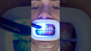 Transformation of Yellow Teeth teethwhitening [upl. by Sirrep]