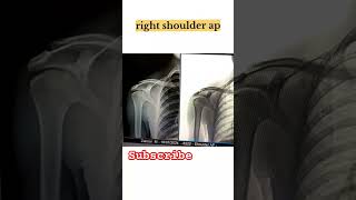 normal right shoulder ap  radiology  viral radiology youtube youtubeshorts anatomy xray [upl. by Arst]